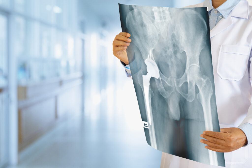Doctor,Looking,At,Total,Hip,Replacement,X-ray,Film,With,Blurred